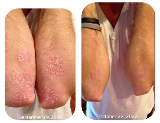 Spray Psoriasis E® TRATAMIENTO ANTIFÚNGICO |Elimina Tiña Inguinal Y Hongos en la Piel